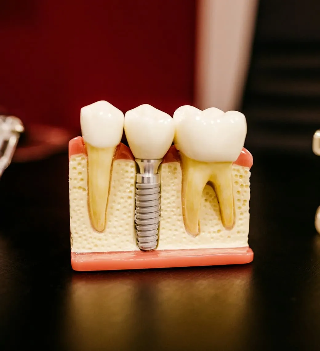 Model szczęki z trzema zębami, w środku implant z koroną.
